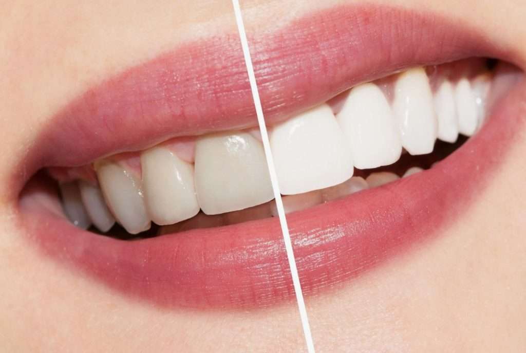 Как сохранить белизну зубов после отбеливания: советы стоматологов